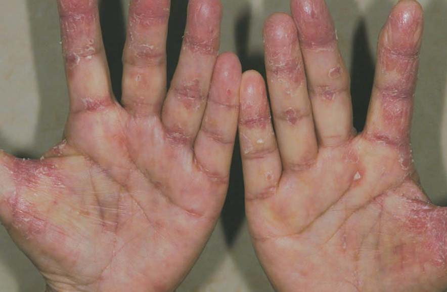 病案6 弥漫性皮肤黏膜念珠菌病